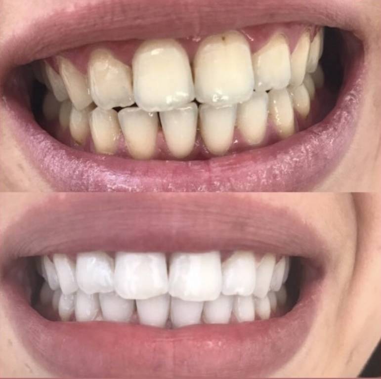 AVANT / APRES Blanchiment dentaire Toulouse (31)